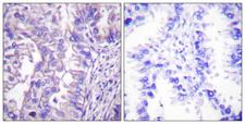 GAD1 + GAD2 Antibody - Peptide - + Immunohistochemical analysis of paraffin-embedded human lung carcinoma tissue using GAD1/2 Antibody.