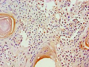 GAD1 / GAD67 Antibody - Immunohistochemistry of paraffin-embedded human breast cancer using antibody at 1:100 dilution.