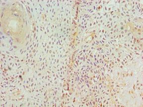 GAD1 / GAD67 Antibody - Immunohistochemistry of paraffin-embedded human breast cancer using antibody at 1:100 dilution.