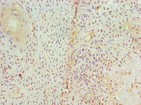 GAD1 / GAD67 Antibody - Immunohistochemistry of paraffin-embedded human breast cancer using GAD1 Antibody at dilution of 1:100