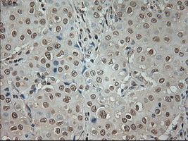 GAD1 / GAD67 Antibody - Immunohistochemical staining of paraffin-embedded Adenocarcinoma of breast tissue using anti-GAD1 mouse monoclonal antibody. (Dilution 1:50).