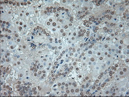 GAD1 / GAD67 Antibody - Immunohistochemical staining of paraffin-embedded Carcinoma of kidney tissue using anti-GAD1 mouse monoclonal antibody. (Dilution 1:50).