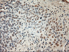 GAD1 / GAD67 Antibody - Immunohistochemical staining of paraffin-embedded Adenocarcinoma of ovary tissue using anti-GAD1 mouse monoclonal antibody. (Dilution 1:50).
