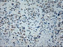 GAD1 / GAD67 Antibody - Immunohistochemical staining of paraffin-embedded Carcinoma of bladder tissue using anti-GAD1 mouse monoclonal antibody. (Dilution 1:50).