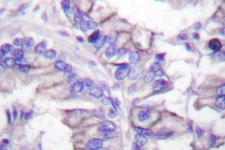 GAD65 Antibody - IHC of GAD1/2 (D572) pAb in paraffin-embedded human lung carcinoma tissue.