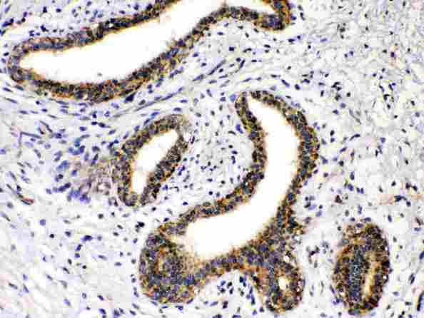 GAD65 Antibody - GAD65 was detected in paraffin-embedded sections of human mammary cancer tissues using rabbit anti-GAD65 Antigen Affinity purified polyclonal antibody (Catalog #) at 1 µg/mL. The immunohistochemical section was developed using SABC method