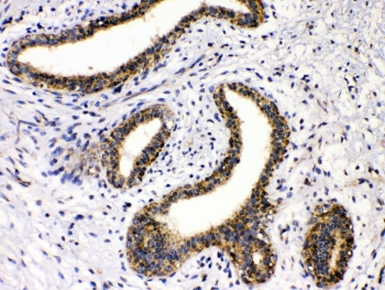 GAD65 Antibody - IHC testing of FFPE human breast cancer tissue with GAD65 antibody at 1ug/ml. Required HIER: steam section in pH6 citrate buffer for 20 min and allow to cool prior to testing.