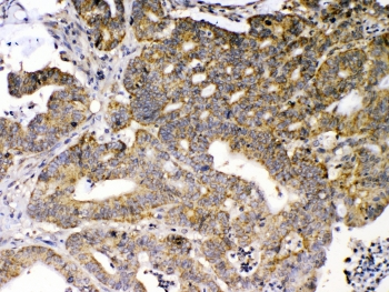 GAD65 Antibody - IHC testing of FFPE human intestinal cancer tissue with GAD65 antibody at 1ug/ml. Required HIER: steam section in pH6 citrate buffer for 20 min and allow to cool prior to testing.