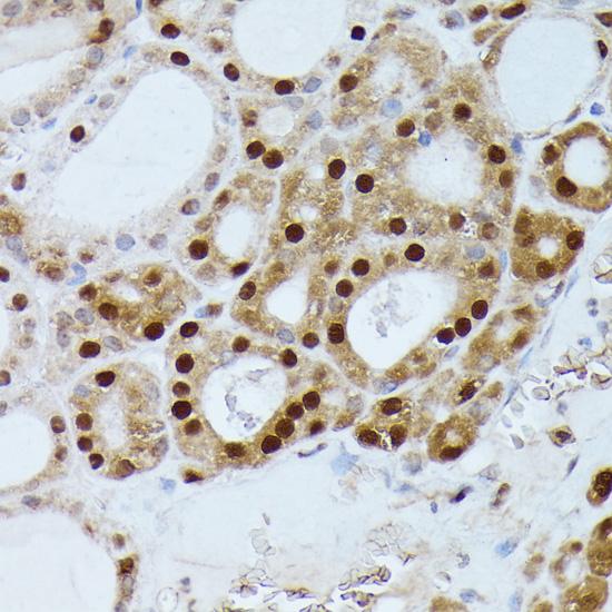 GADD45A / GADD45 Antibody - Immunohistochemistry of paraffin-embedded Human thyroid cancer using GADD45A Polyclonal Antibody at dilution of 1:100 (40x lens).
