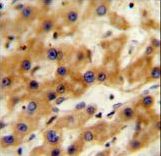 GAGE13 Antibody - GAGE13 Antibody immunohistochemistry of formalin-fixed and paraffin-embedded human hepatocarcinoma followed by peroxidase-conjugated secondary antibody and DAB staining.