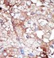 GAK Antibody - Formalin-fixed and paraffin-embedded human cancer tissue reacted with the primary antibody, which was peroxidase-conjugated to the secondary antibody, followed by DAB staining. This data demonstrates the use of this antibody for immunohistochemistry; clinical relevance has not been evaluated. BC = breast carcinoma; HC = hepatocarcinoma.