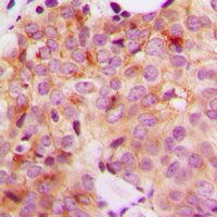 GAK Antibody - Immunohistochemical analysis of GAK staining in human breast cancer formalin fixed paraffin embedded tissue section. The section was pre-treated using heat mediated antigen retrieval with sodium citrate buffer (pH 6.0). The section was then incubated with the antibody at room temperature and detected using an HRP conjugated compact polymer system. DAB was used as the chromogen. The section was then counterstained with hematoxylin and mounted with DPX.