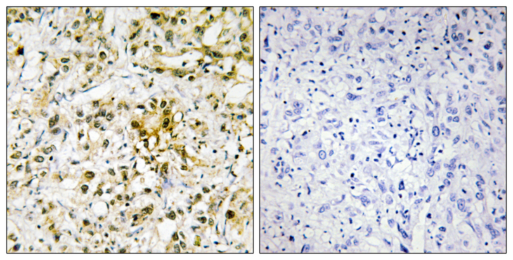 GAL4 / Galectin 4 Antibody - Immunohistochemistry analysis of paraffin-embedded human liver carcinoma tissue, using LEG4 Antibody. The picture on the right is blocked with the synthesized peptide.