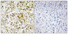 GAL4 / Galectin 4 Antibody - Immunohistochemistry analysis of paraffin-embedded human liver carcinoma tissue, using LEG4 Antibody. The picture on the right is blocked with the synthesized peptide.