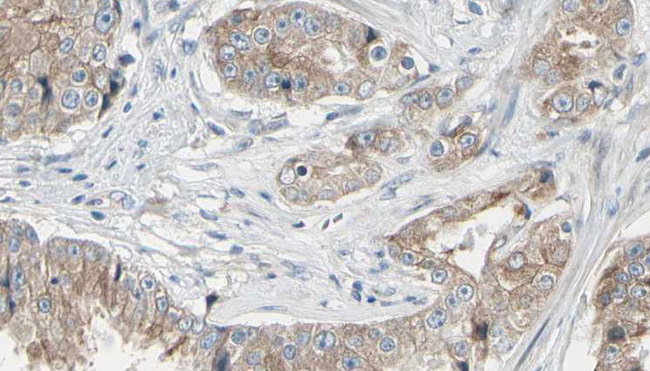 GAL4 / Galectin 4 Antibody - 1:100 staining human prostate tissue by IHC-P. The sample was formaldehyde fixed and a heat mediated antigen retrieval step in citrate buffer was performed. The sample was then blocked and incubated with the antibody for 1.5 hours at 22°C. An HRP conjugated goat anti-rabbit antibody was used as the secondary.