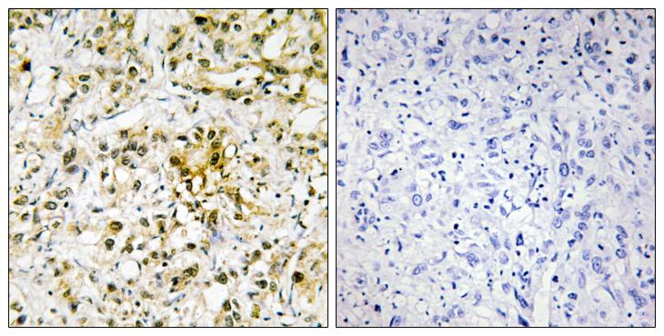 GAL4 / Galectin 4 Antibody - Peptide - + Immunohistochemistry analysis of paraffin-embedded human liver carcinoma tissue using LEG4 antibody.