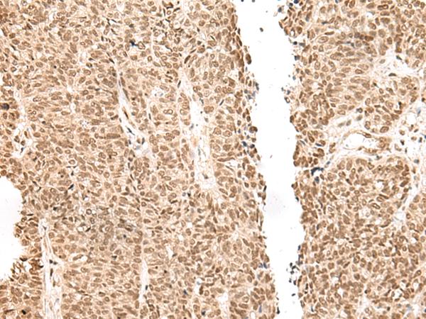 GAL4 / Galectin 4 Antibody - Immunohistochemistry of paraffin-embedded Human ovarian cancer tissue  using LGALS4 Polyclonal Antibody at dilution of 1:30(×200)
