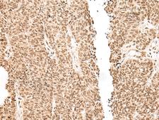 GAL4 / Galectin 4 Antibody - Immunohistochemistry of paraffin-embedded Human ovarian cancer tissue  using LGALS4 Polyclonal Antibody at dilution of 1:30(×200)