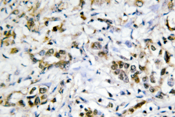GAL4 / Galectin 4 Antibody - IHC of Galectin-4 (K83) pAb in paraffin-embedded human liver carcinoma tissue.