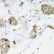 GALC / Galactocerebrosidase Antibody - Immunohistochemistry of paraffin-embedded human gastric cancer tissue.