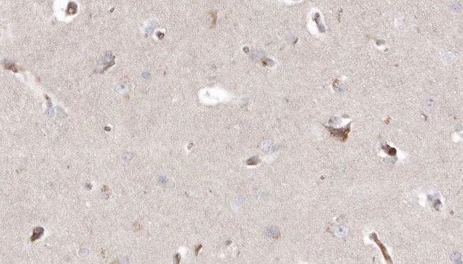 GALC / Galactocerebrosidase Antibody - 1:100 staining human brain carcinoma tissue by IHC-P. The sample was formaldehyde fixed and a heat mediated antigen retrieval step in citrate buffer was performed. The sample was then blocked and incubated with the antibody for 1.5 hours at 22°C. An HRP conjugated goat anti-rabbit antibody was used as the secondary.