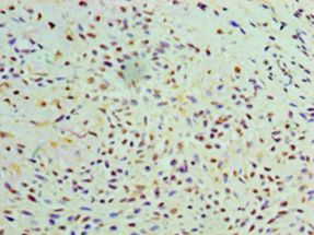 GALE / UDP-Glucose 4-Epimerase Antibody - Immunohistochemistry of paraffin-embedded human breast cancer using antibody at 1:100 dilution.  This image was taken for the unconjugated form of this product. Other forms have not been tested.