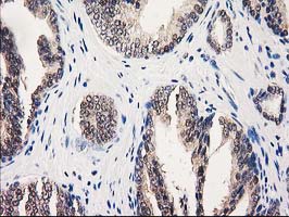 GALE / UDP-Glucose 4-Epimerase Antibody - IHC of paraffin-embedded Carcinoma of Human prostate tissue using anti-GALE mouse monoclonal antibody.