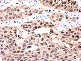 GALE / UDP-Glucose 4-Epimerase Antibody - IHC of paraffin-embedded Carcinoma of Human bladder tissue using anti-GALE mouse monoclonal antibody.