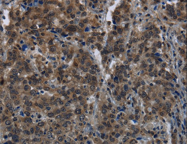 GALK1 / GK1 Antibody - Immunohistochemistry of paraffin-embedded Human liver cancer using GK Polyclonal Antibody at dilution of 1:60.
