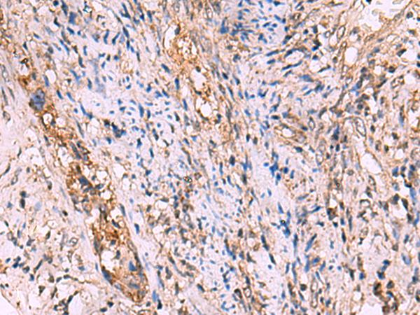 GALK2 Antibody - Immunohistochemistry of paraffin-embedded Human cervical cancer tissue  using GALK2 Polyclonal Antibody at dilution of 1:95(×200)