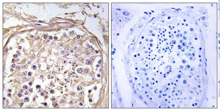 GALNAC4ST-2 / CHST9 Antibody - Peptide - + Immunohistochemistry analysis of paraffin-embedded human breast carcinoma tissue using CHST9 antibody.