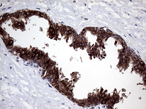 GALNT10 Antibody - Immunohistochemical staining of paraffin-embedded Carcinoma of Human prostate tissue using anti-GALNT10 mouse monoclonal antibody. (Heat-induced epitope retrieval by 1mM EDTA in 10mM Tris buffer. (pH8.5) at 120°C for 3 min. (1:500)