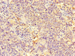 GALNT11 Antibody - Immunohistochemistry of paraffin-embedded human cervical cancer at dilution of 1:100