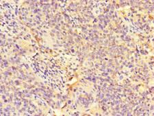 GALNT11 Antibody - Immunohistochemistry of paraffin-embedded human cervical cancer at dilution of 1:100