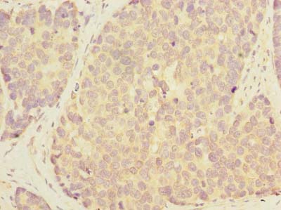 GALNT12 Antibody - Immunohistochemistry of paraffin-embedded human gastric cancer using antibody at dilution of 1:100.