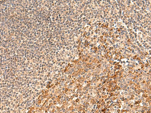 GALNT12 Antibody - Immunohistochemistry of paraffin-embedded Human tonsil tissue  using GALNT12 Polyclonal Antibody at dilution of 1:60(×200)