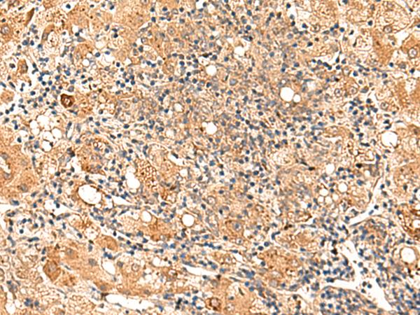 GALNT12 Antibody - Immunohistochemistry of paraffin-embedded Human liver cancer tissue  using GALNT12 Polyclonal Antibody at dilution of 1:70(×200)