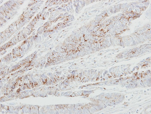 GALNT2 Antibody - IHC of paraffin-embedded Colon ca using GALNT2 antibody at 1:250 dilution.