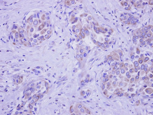 GALNT2 Antibody - IHC of paraffin-embedded Breast ca, using GALNT2 antibody at 1:250 dilution.