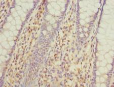 GALNT2 Antibody - Immunohistochemistry of paraffin-embedded human colon cancer at dilution 1:100