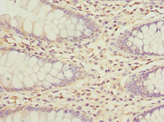 GALNT2 Antibody - Immunohistochemistry of paraffin-embedded human colon cancer at dilution 1:100