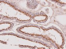 GALNT7 Antibody - IHC of paraffin-embedded Endometrial CA using GALNT7 antibody at 1:100 dilution.