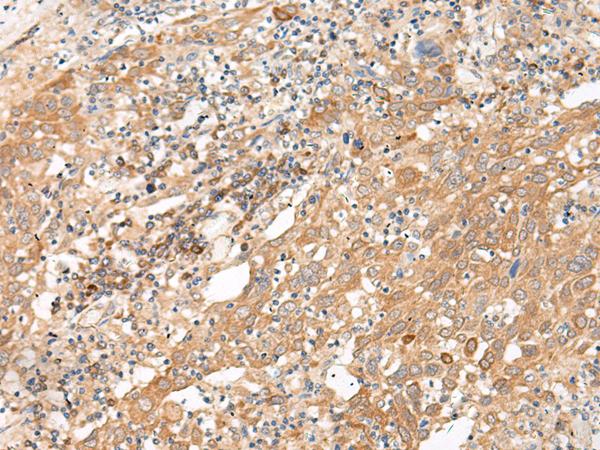 GALP / Alarin Antibody - Immunohistochemistry of paraffin-embedded Human cervical cancer tissue  using GALP Polyclonal Antibody at dilution of 1:45(×200)