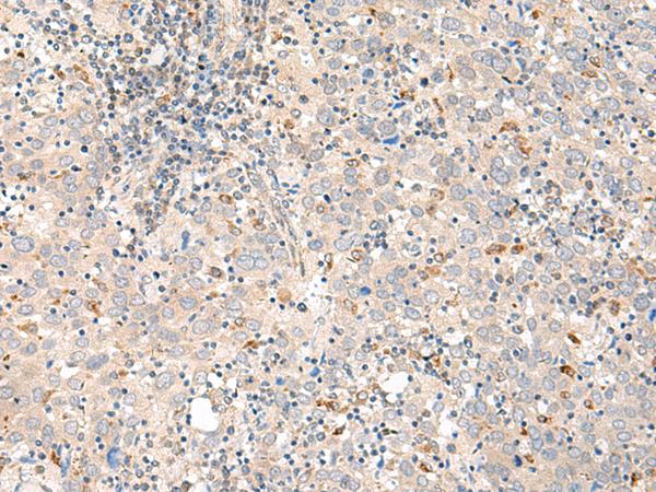 GALR1 / Galanin Receptor 1 Antibody - Immunohistochemistry of paraffin-embedded Human cervical cancer tissue  using GALR1 Polyclonal Antibody at dilution of 1:60(×200)