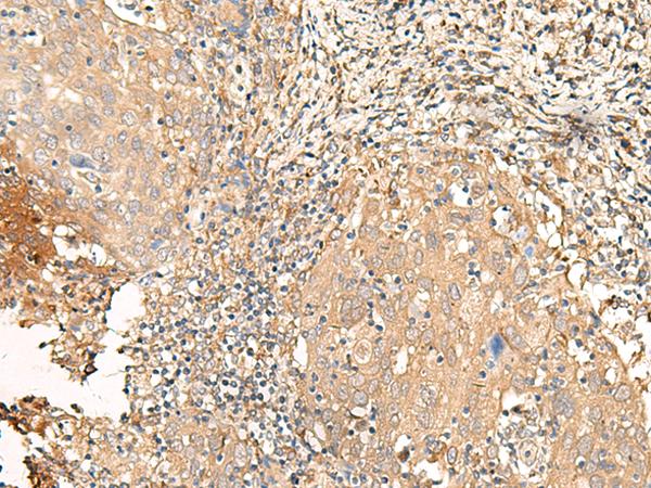 GALR2 / Galanin Receptor 2 Antibody - Immunohistochemistry of paraffin-embedded Human cervical cancer tissue  using GALR2 Polyclonal Antibody at dilution of 1:25(×200)