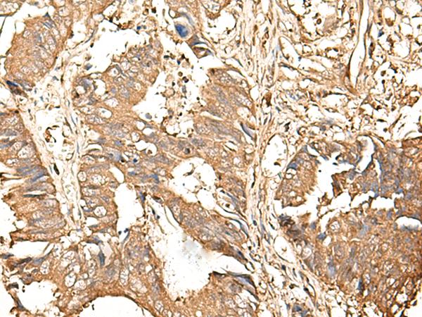 GALR2 / Galanin Receptor 2 Antibody - Immunohistochemistry of paraffin-embedded Human colorectal cancer tissue  using GALR2 Polyclonal Antibody at dilution of 1:25(×200)