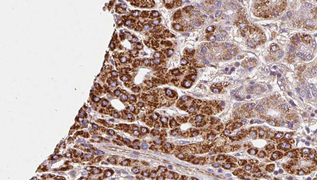 GALR3 / Galanin Receptor 3 Antibody - 1:100 staining human liver carcinoma tissues by IHC-P. The sample was formaldehyde fixed and a heat mediated antigen retrieval step in citrate buffer was performed. The sample was then blocked and incubated with the antibody for 1.5 hours at 22°C. An HRP conjugated goat anti-rabbit antibody was used as the secondary.