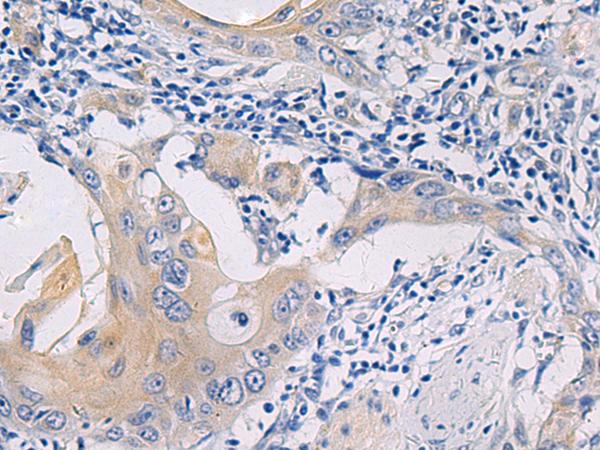 GALR3 / Galanin Receptor 3 Antibody - Immunohistochemistry of paraffin-embedded Human esophagus cancer tissue  using GALR3 Polyclonal Antibody at dilution of 1:50(×200)