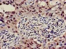 GALT4 / B3GALT4 Antibody - Immunohistochemistry of paraffin-embedded human lung cancer at dilution of 1:100