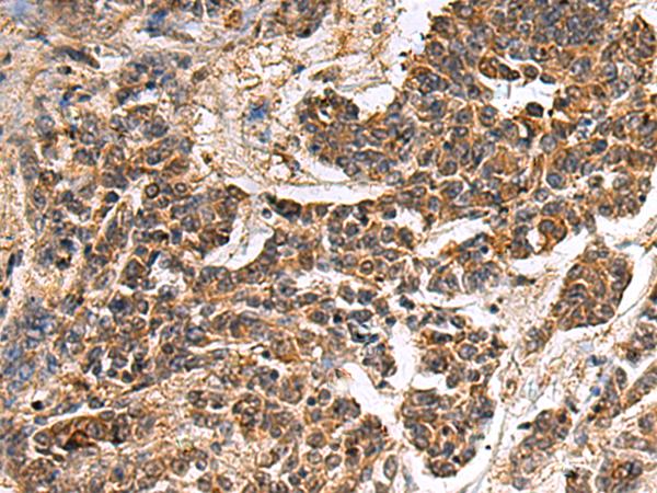 GANAB / Alpha Glucosidase II Antibody - Immunohistochemistry of paraffin-embedded Human colorectal cancer tissue  using GANAB Polyclonal Antibody at dilution of 1:30(×200)